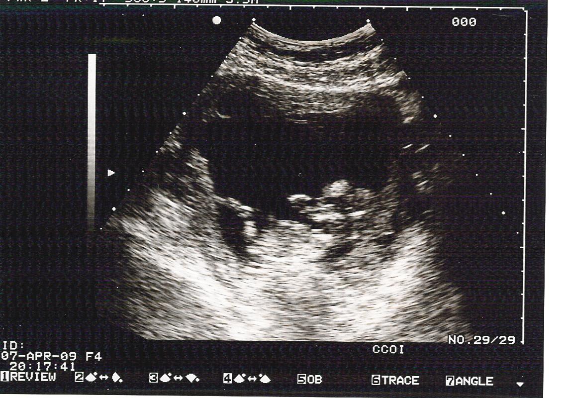 [IVF-Gestational+Sac+12+weeks.jpg]