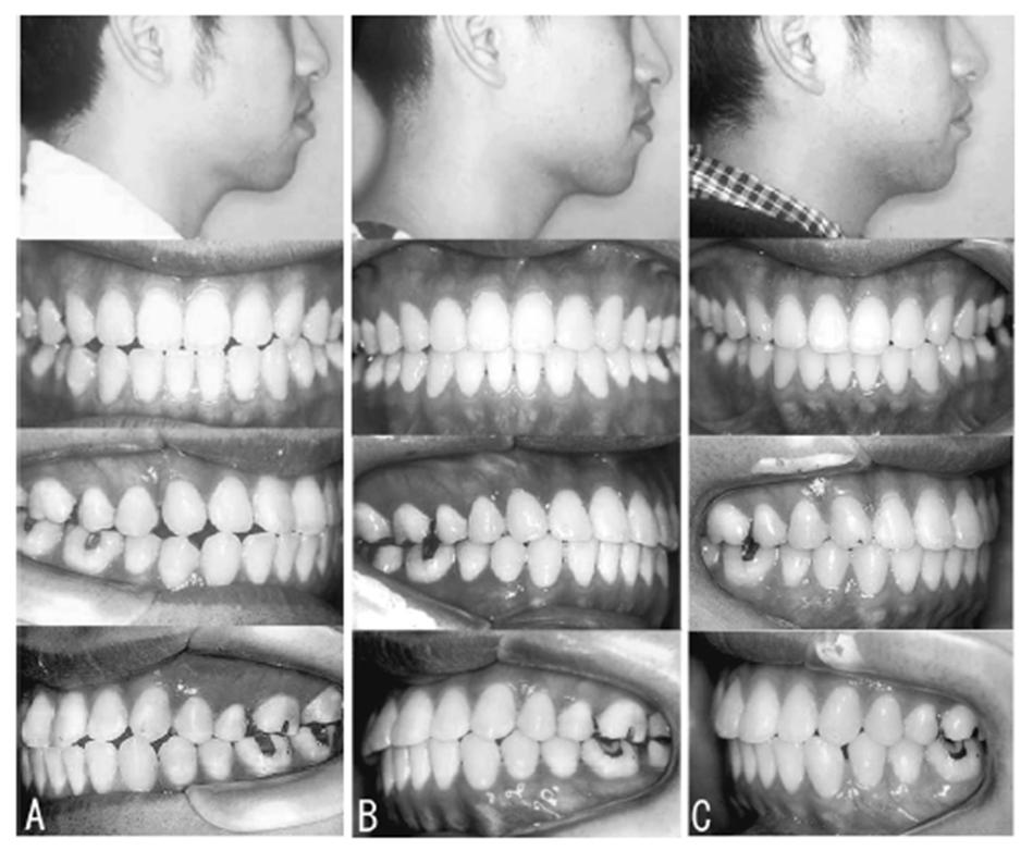 ORTODONTIA CONTEMPORÂNEA Tratamento da Classe lll em adultos utilizando aparelho extrabucal J