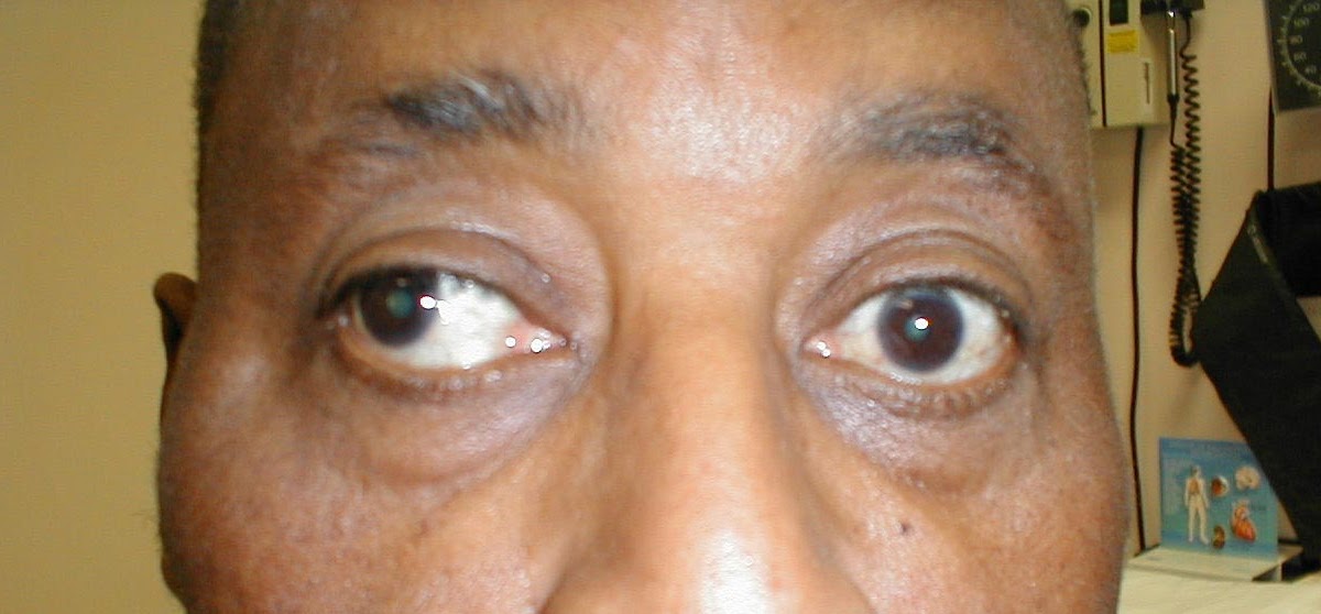 Doctors Gates CN 3 Palsy (Oculomotor nerve Palsy)