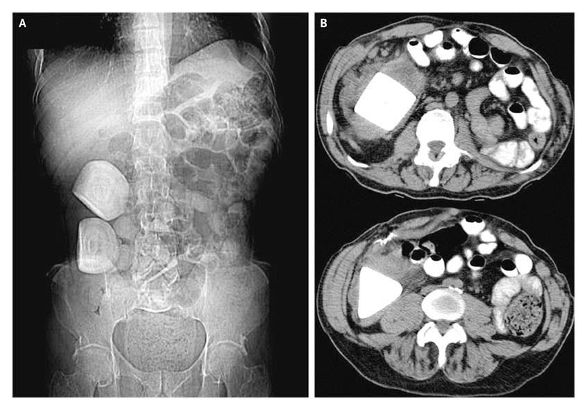 ON RADIOLOGY Calcifications in a Continent Urinary Diversion