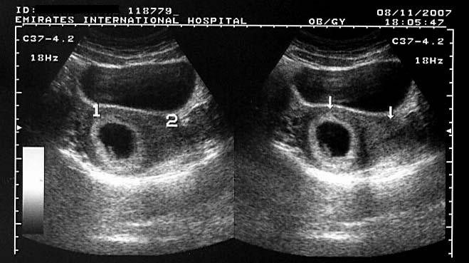 ON - RADIOLOGY: Ultrasound images of Bicornuate uterus with gestation sac