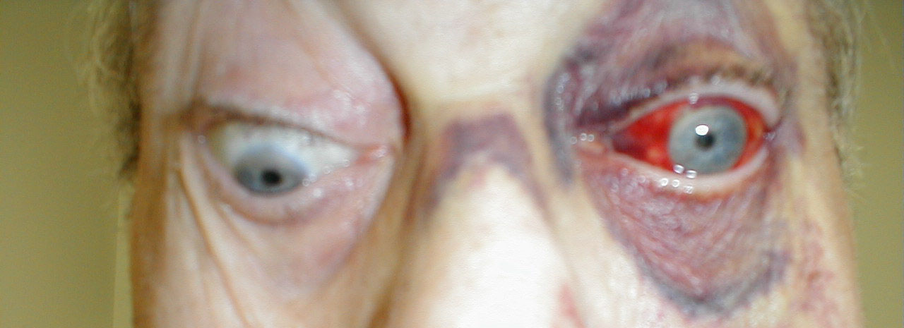 Doctors Gates: OMG....Extraoccular Muscle Entrapment