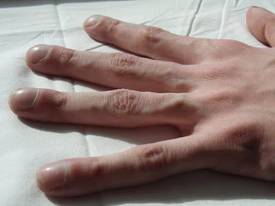Finger clubbing also may occur, without evident underlying disease