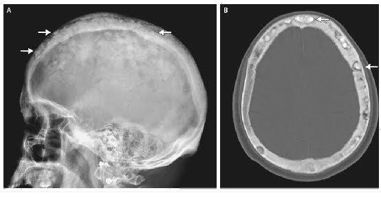 ON - RADIOLOGY: “Cotton Wool” Appearance of Paget's Disease
