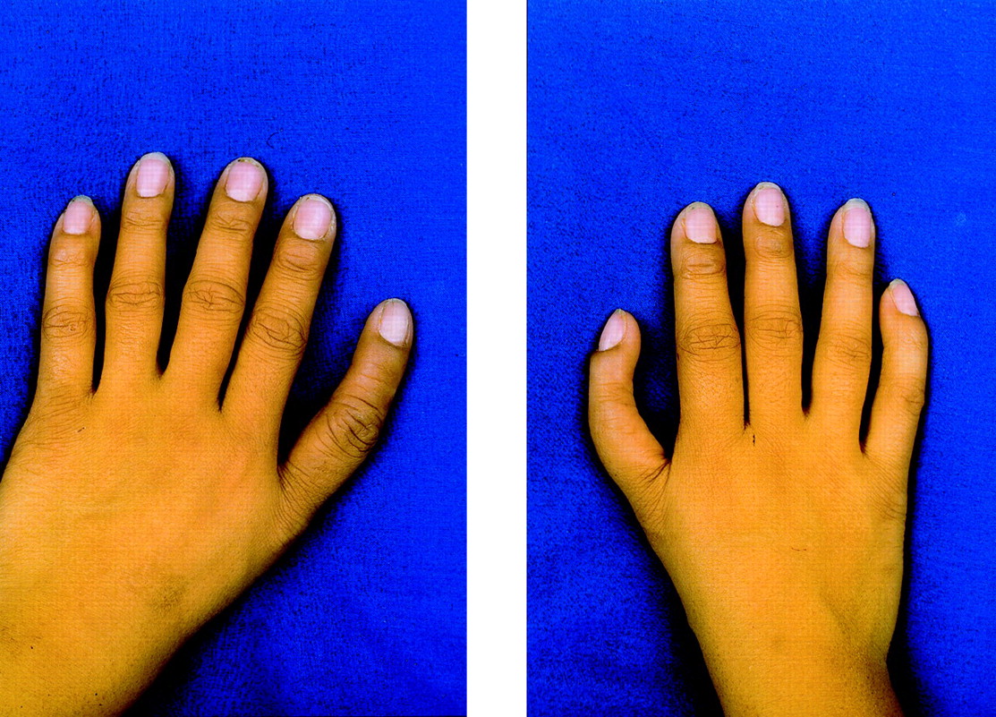 Heart Hand Syndrome