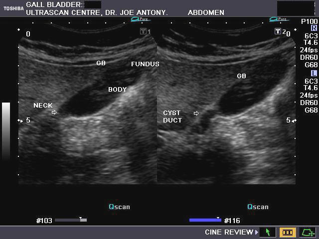 ON - RADIOLOGY: Normal Anatomy of Gall bladder