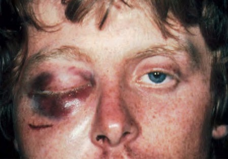 exophthalmos