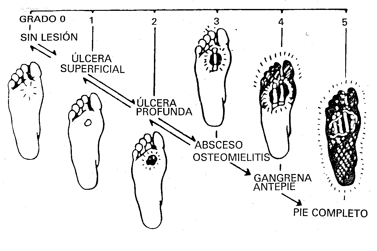 [esquema+pie+diabetico.gif]