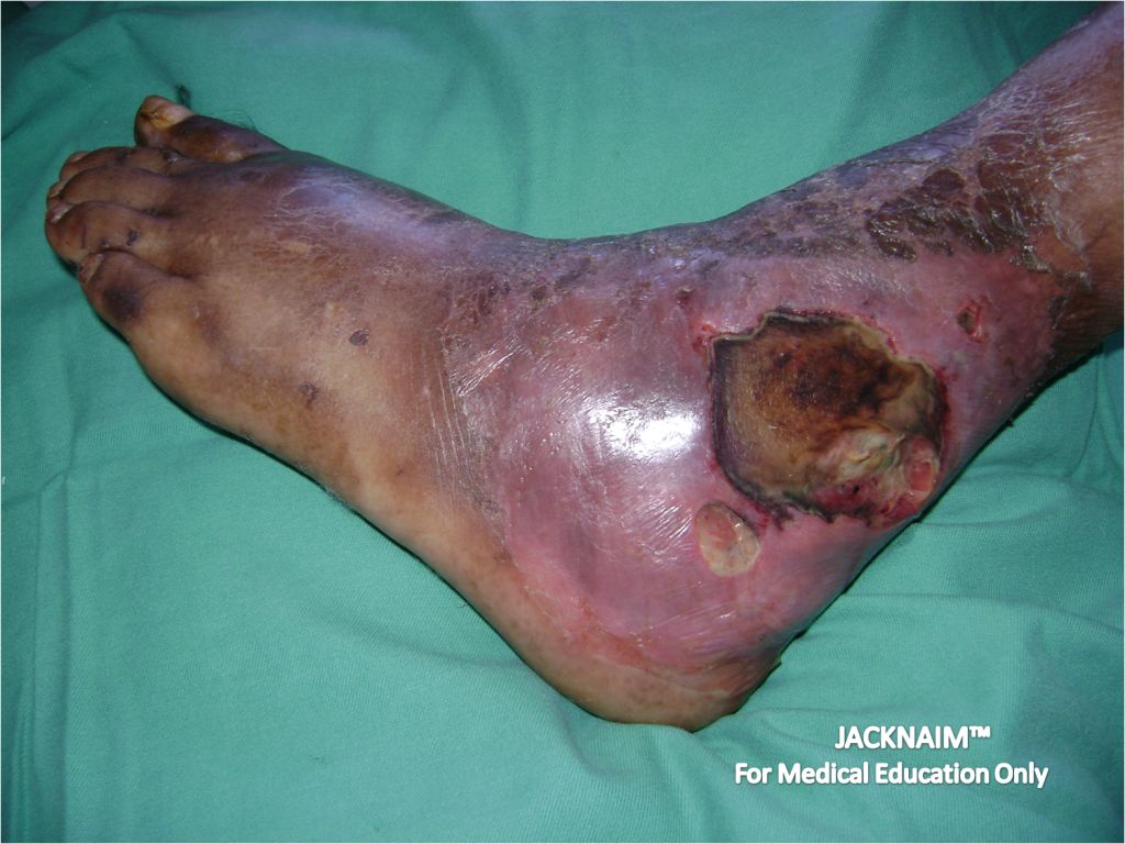 Diabetic Foot Infection