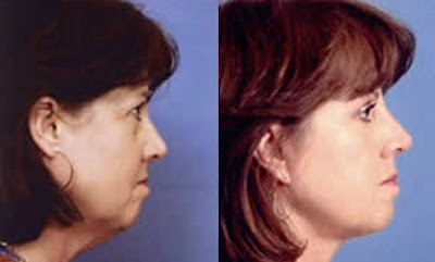 price cost of facelift