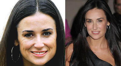 Anti Aging Treatments: Demi Moore Plastic Surgery