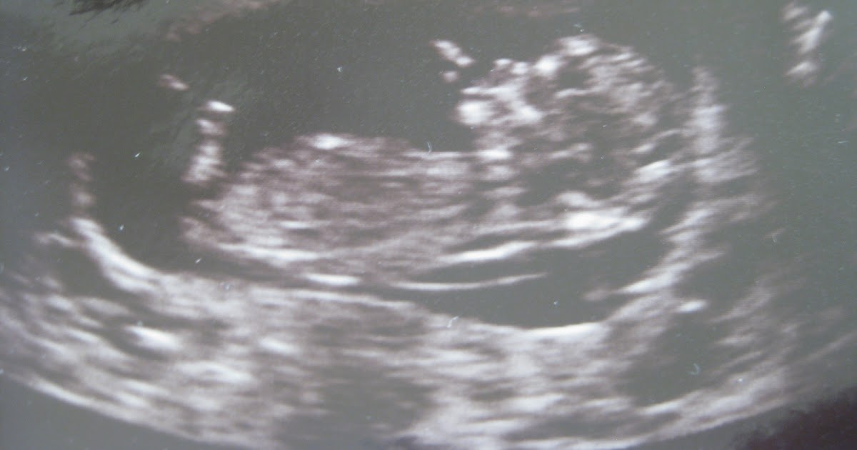 12 week sonogram 12 week sonogram