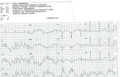 Abnormal-EKG-Artifact-Bad-Computer-Interpretation
