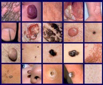 Skin Diseases Pictures