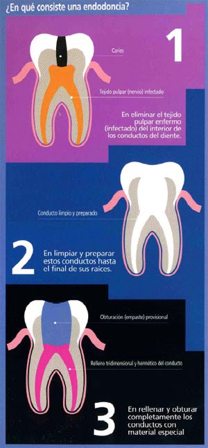 Endodoncia