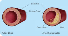 masalah saluran darah ke jantung