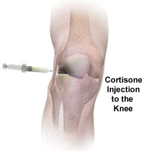 Steroids for knee joint pain