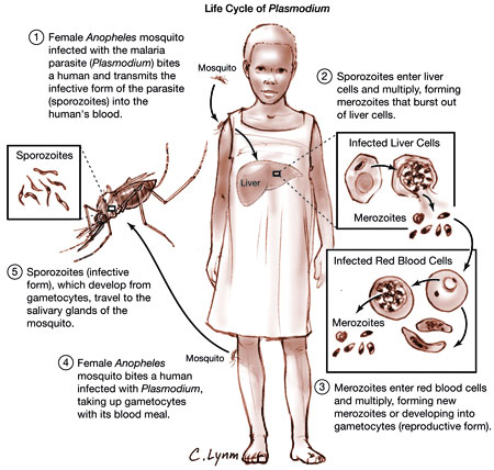 symptoms malaria