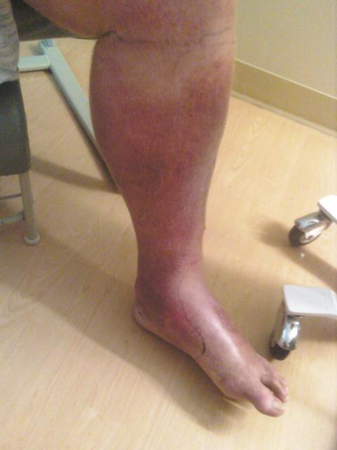 cellulitis definition