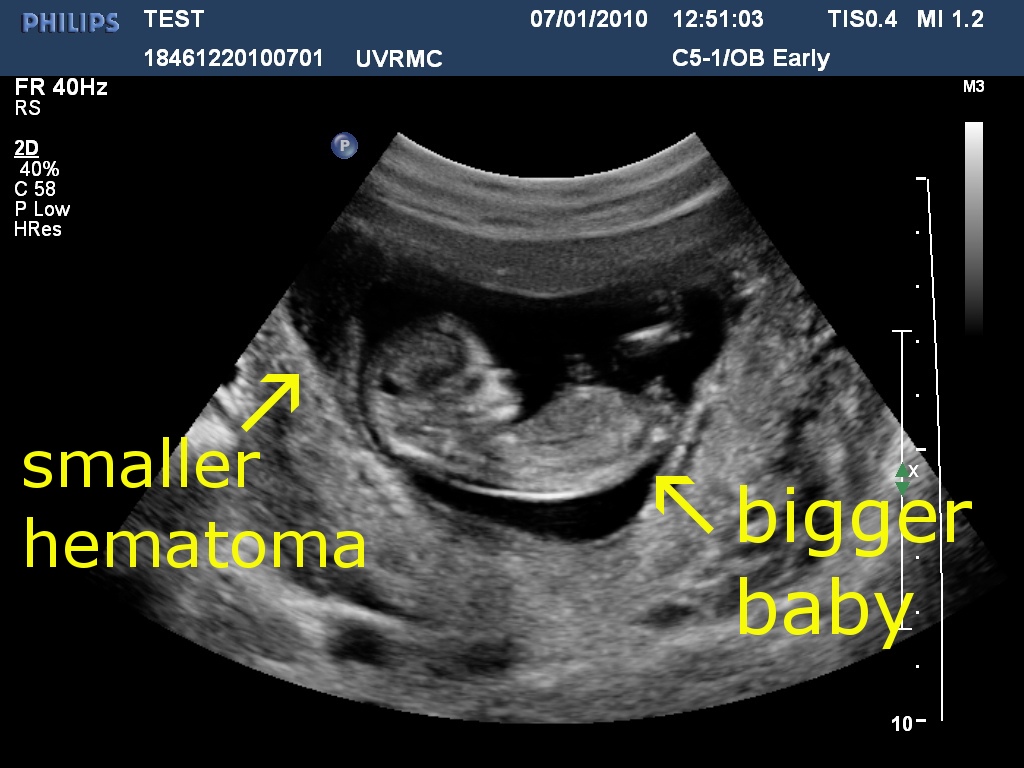 subchorionic hematoma weeks bleeding spotting sch continued another before