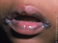 angular cheilitis, angular cheilitis symptoms