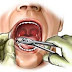Obat Sakit Gigi Dan Waktu Yang Tepat Cabut Gigi