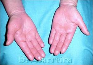 eritema palmar