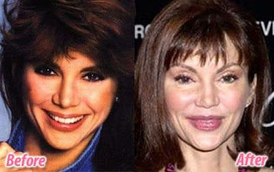 celebrity plastic surgery celebrity plastic surgery
