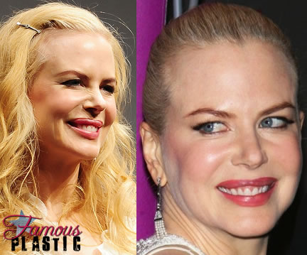 Famous Pictures Celebrities on Best Plastic Surgery  Who Celebrity Plastic Surgery