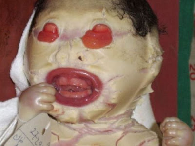 Worst Baby Deformities