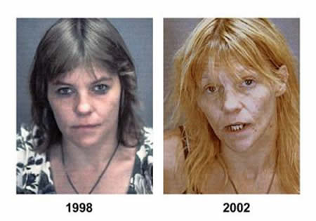 The picture shows a women before she took drugs and after