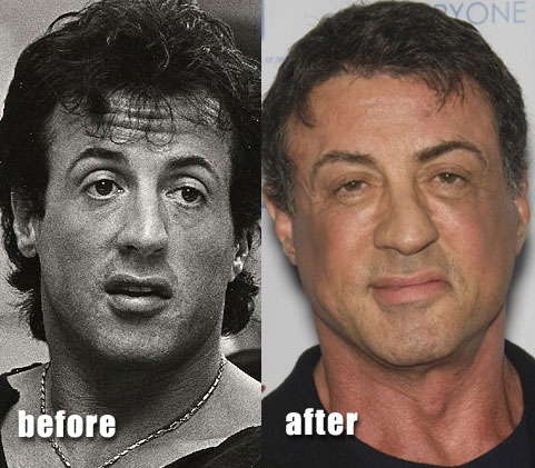 Kathy Gifford Plastic Surgery on Sylvester Stallone Plastic Surgery