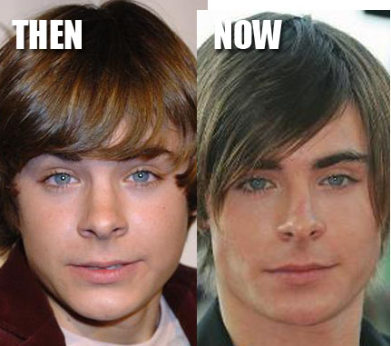 Nose Plastic Surgery on Zac Efron Nose Job   Cosmetic Plastic Surgery