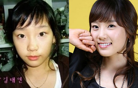 Sunny Snsd Plastic Surgery on Sunny S Eyes Look Larger  There S A Surgery That S Not Double Eyelid