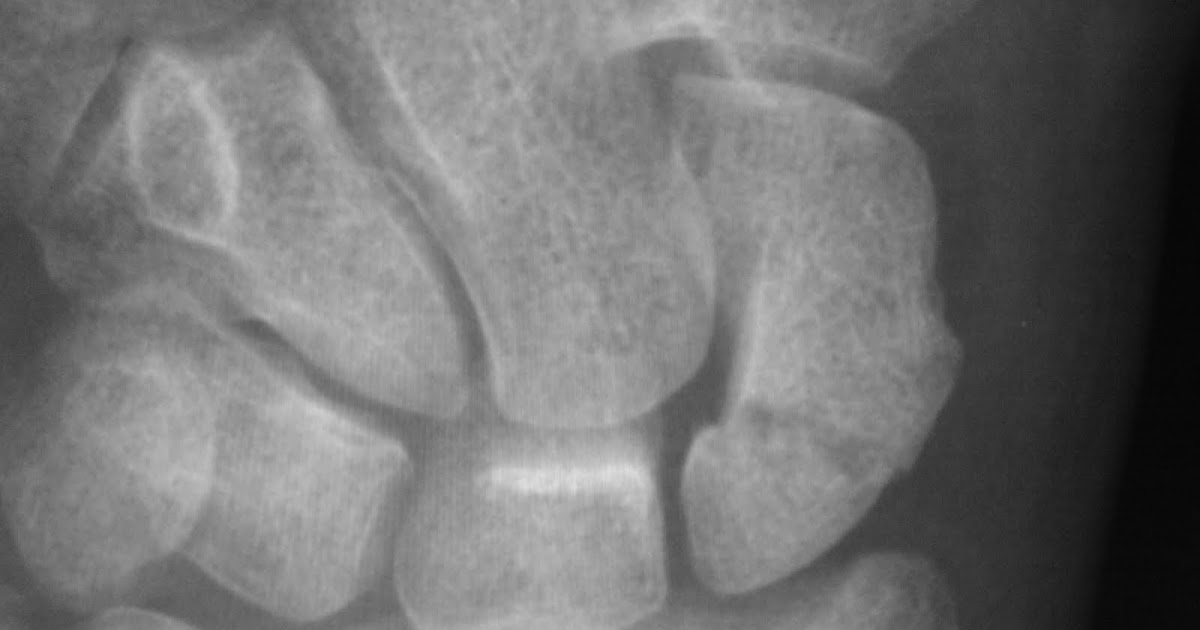 Daily Dose Avascular necrosis of scaphoid