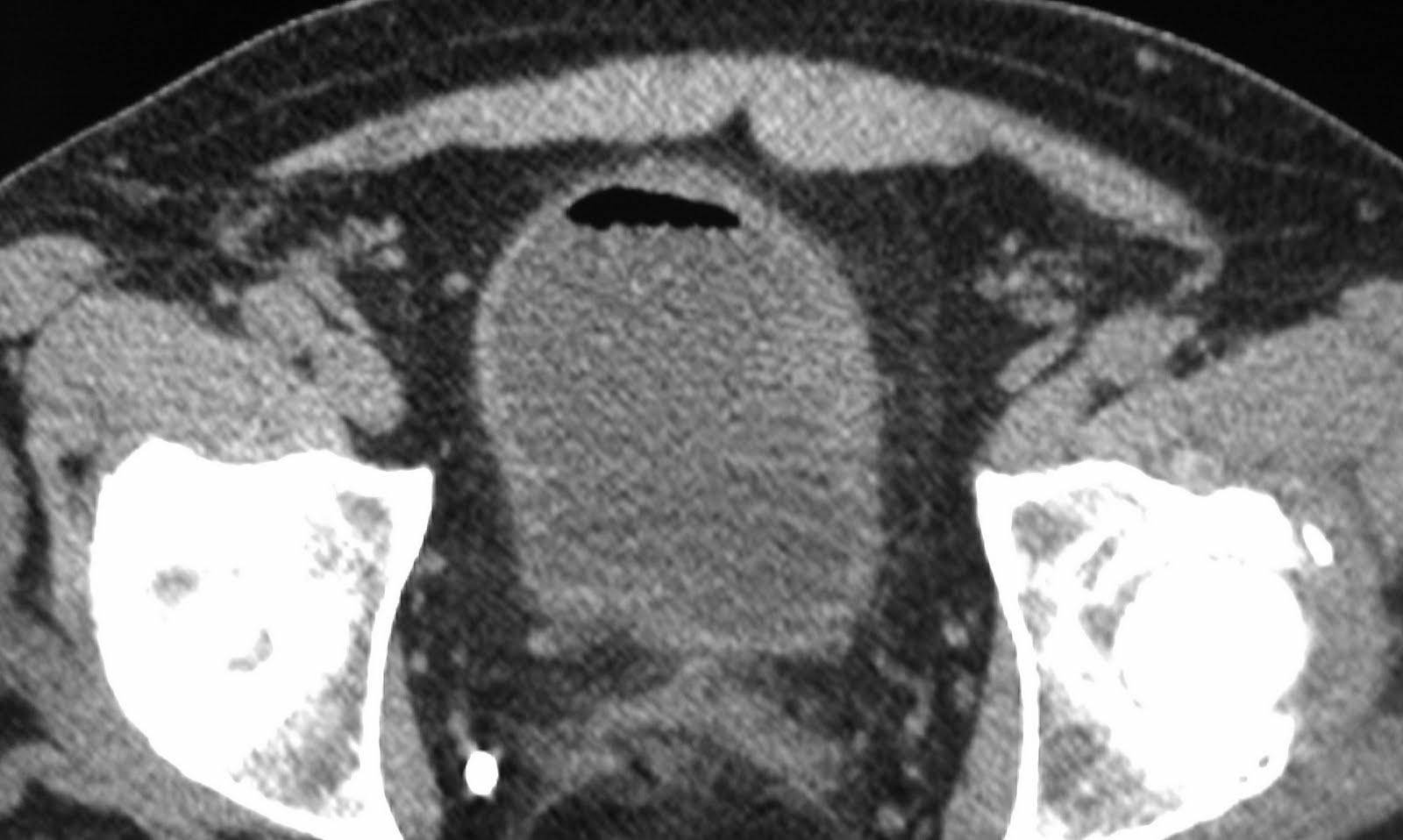 Daily Dose: Colovesical fistula