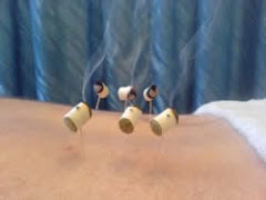 MOXIBUSTIÓN EN COLUMNA LUMBAR