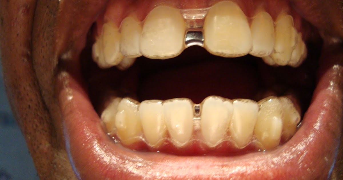 tray invisalign