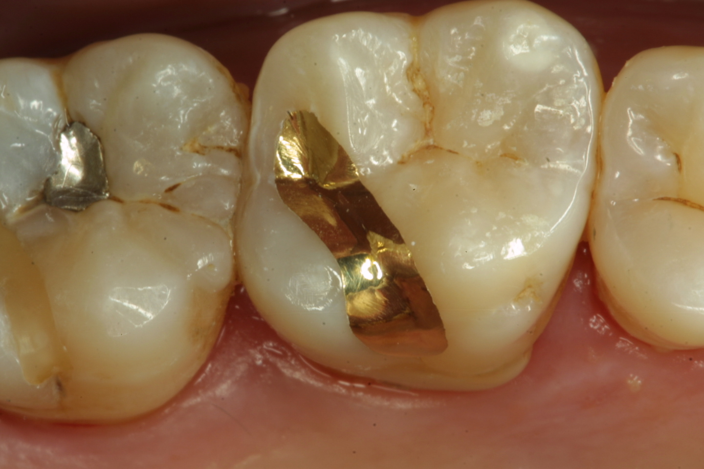 Updates in Dental Excellence Gold Inlay Examples on My Happy Patients