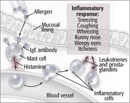 Allergic Rhinitis Diagram