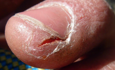 Hard Blister Thing In Kids Heel Hard Blister Thing In Kids Heel