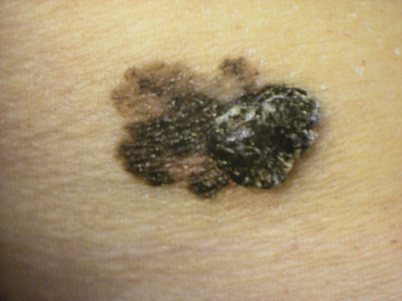 A Touch of Plastic Surgery TANNING BEDS AND SKIN CANCER