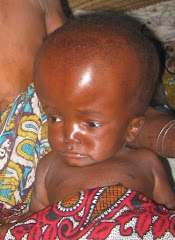 hydrocephalus baby