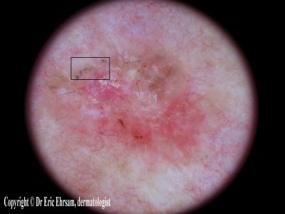 subcorneal hemorrhage