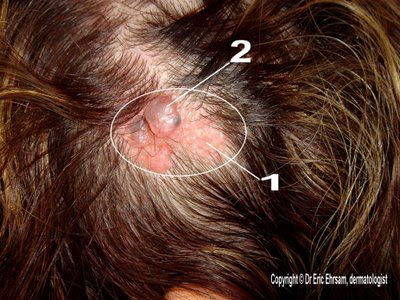 Warts On Scalp