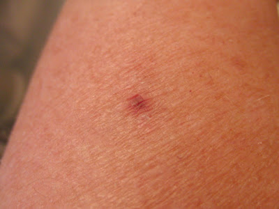 spider bite pictures day 1. spider bite blister pictures.