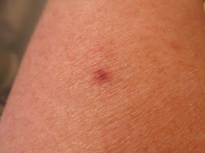 white tail spider bite white tail spider bite pictures. white tail spider bite