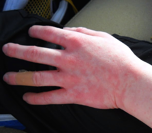 Life With Food Allergies Cold Urticaria