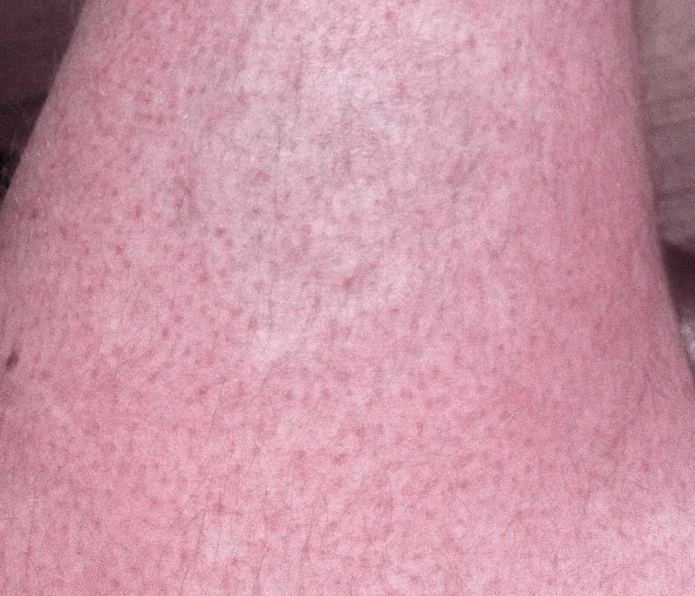 Atripla Rash Pictures