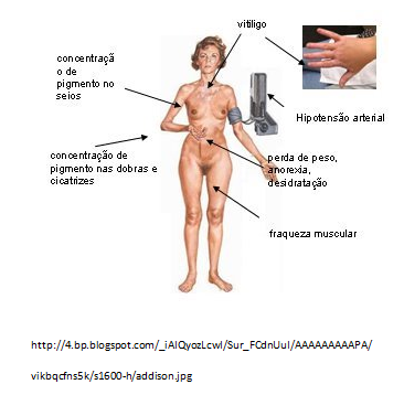 Sindrome de cushing por esteroides